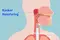 Penyebab dan Gejala Kanker Nasofaring
